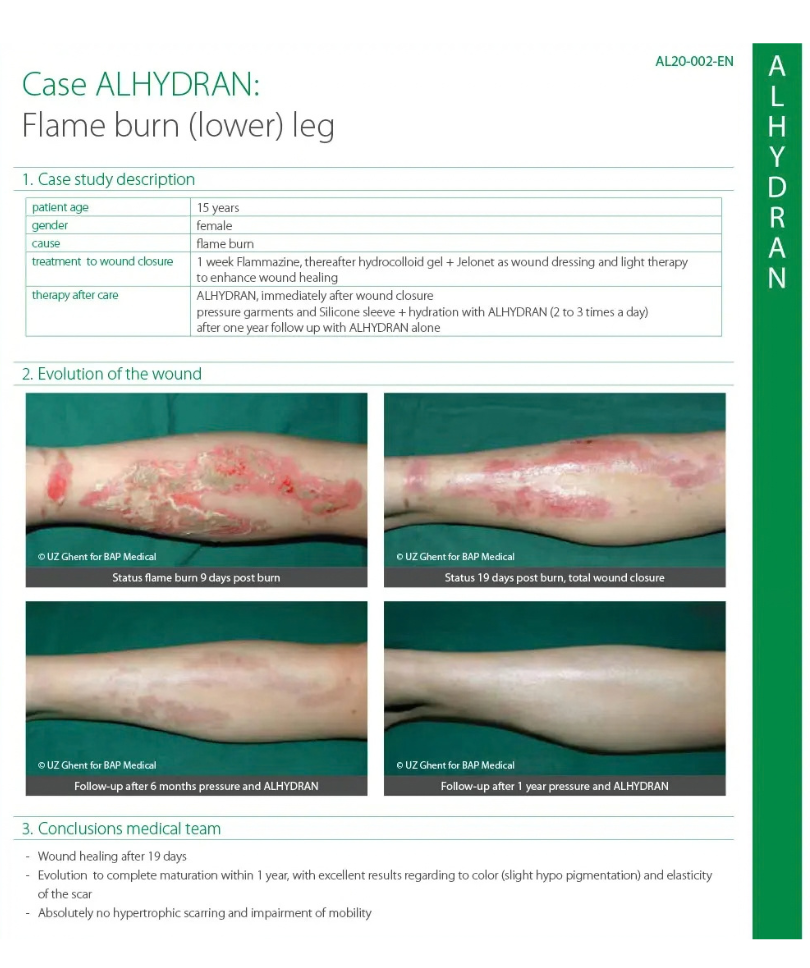 Flame Burn
