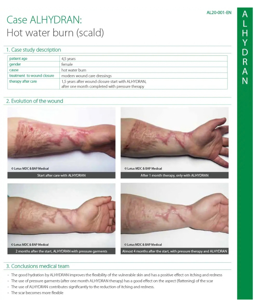 Hot Water Burn
