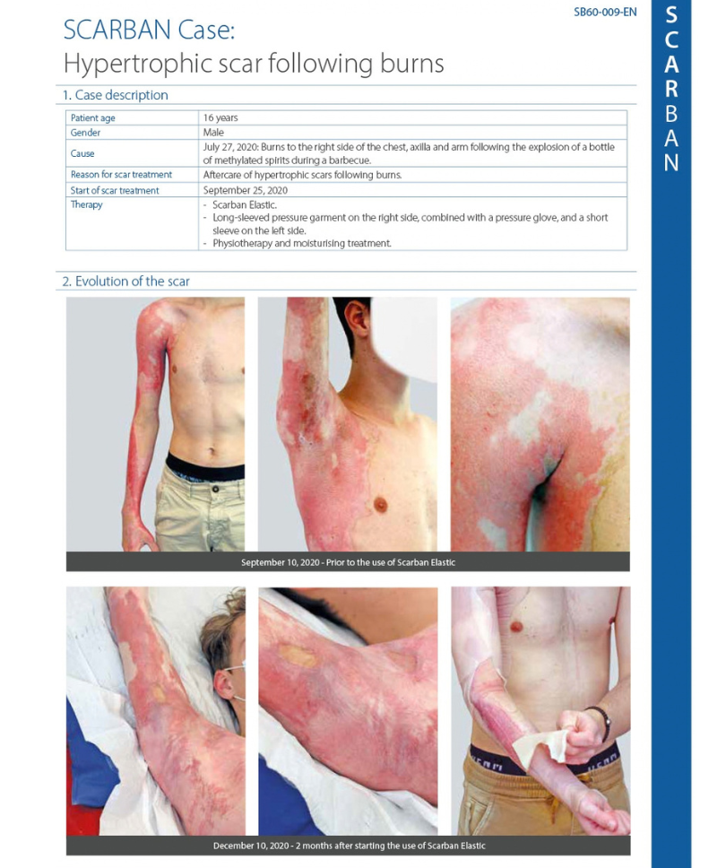 Hypertrophic Scars Post Burn