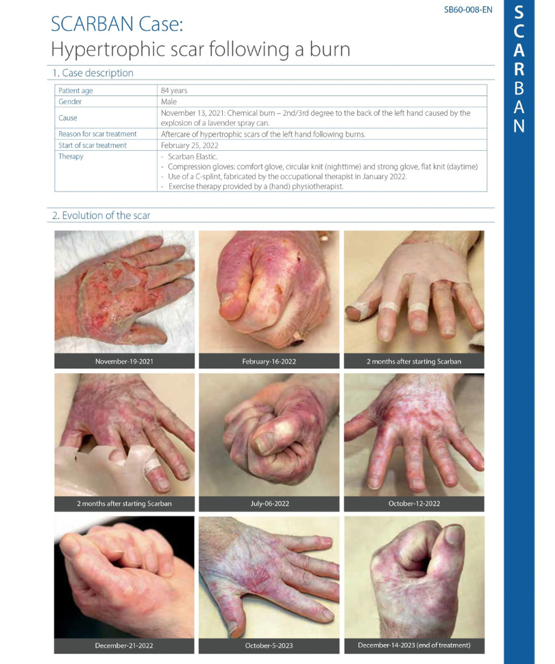 Hypertrophic Scars Post Hand Burn