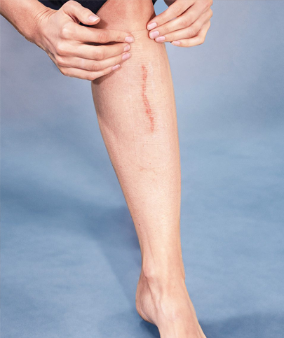 Wound Scar Management