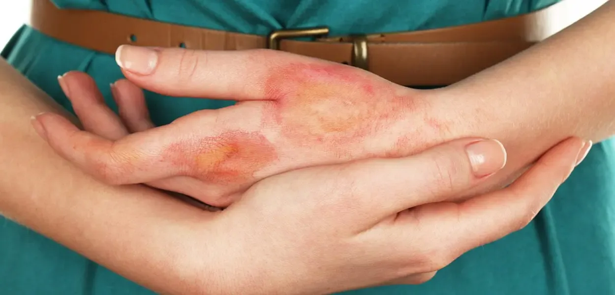 Preventing scars after a burn wound 1250x600