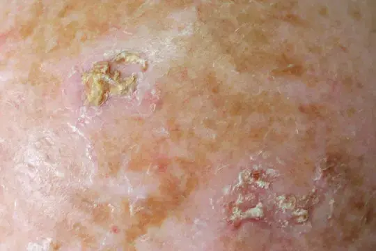 ALHYDRAN actinic keratosis 02 540x360