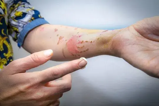 ALHYDRAN burn wound 01 540x360