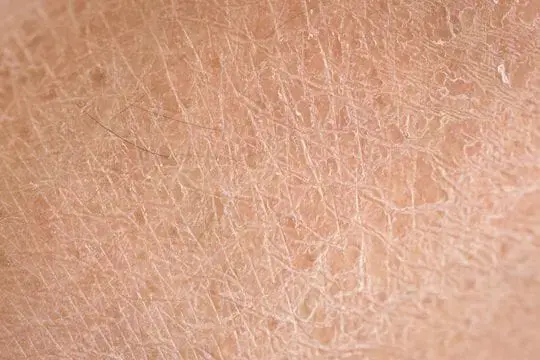 ALHYDRAN dry skin 01 540x360