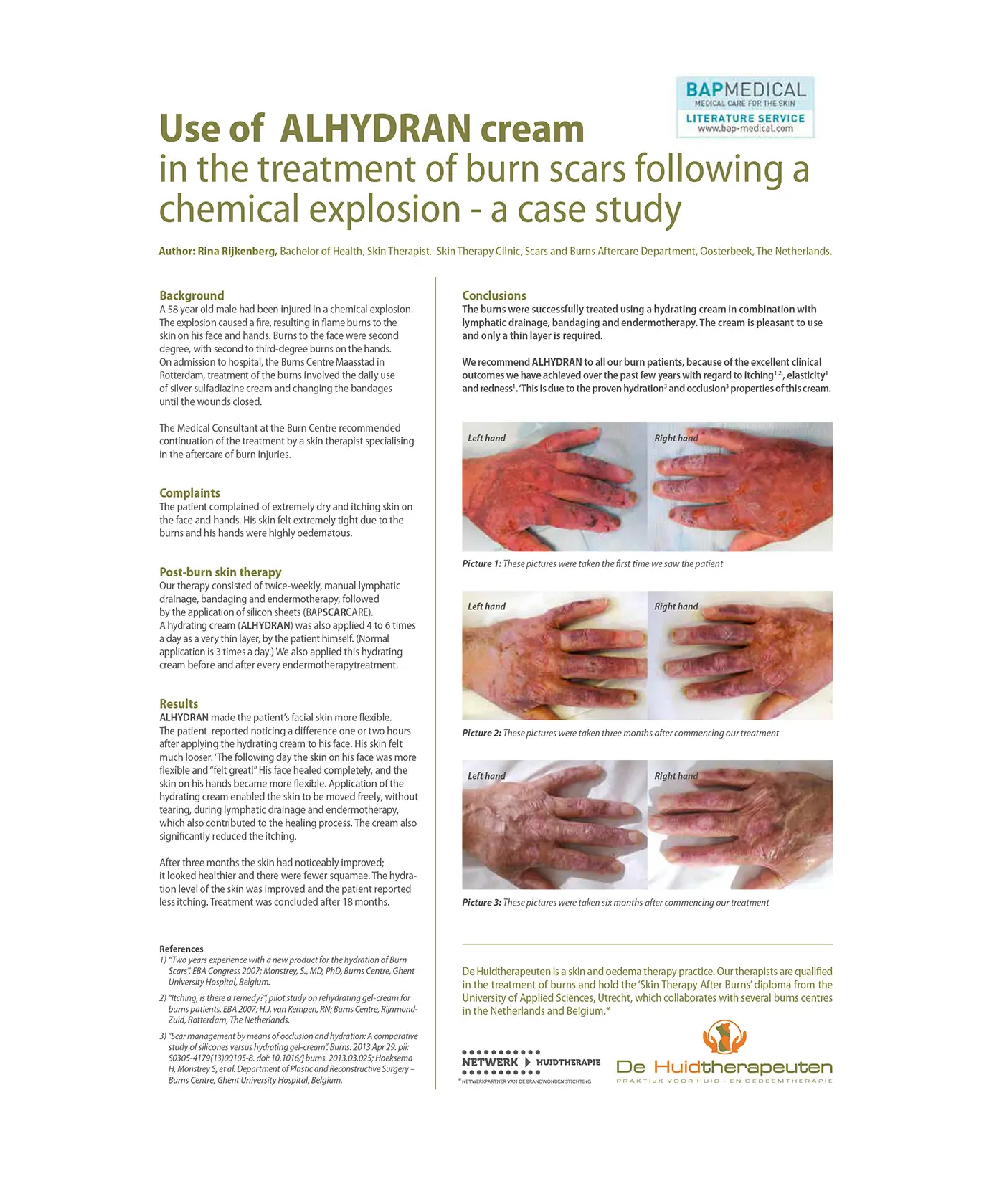 Alhydran for scars 01