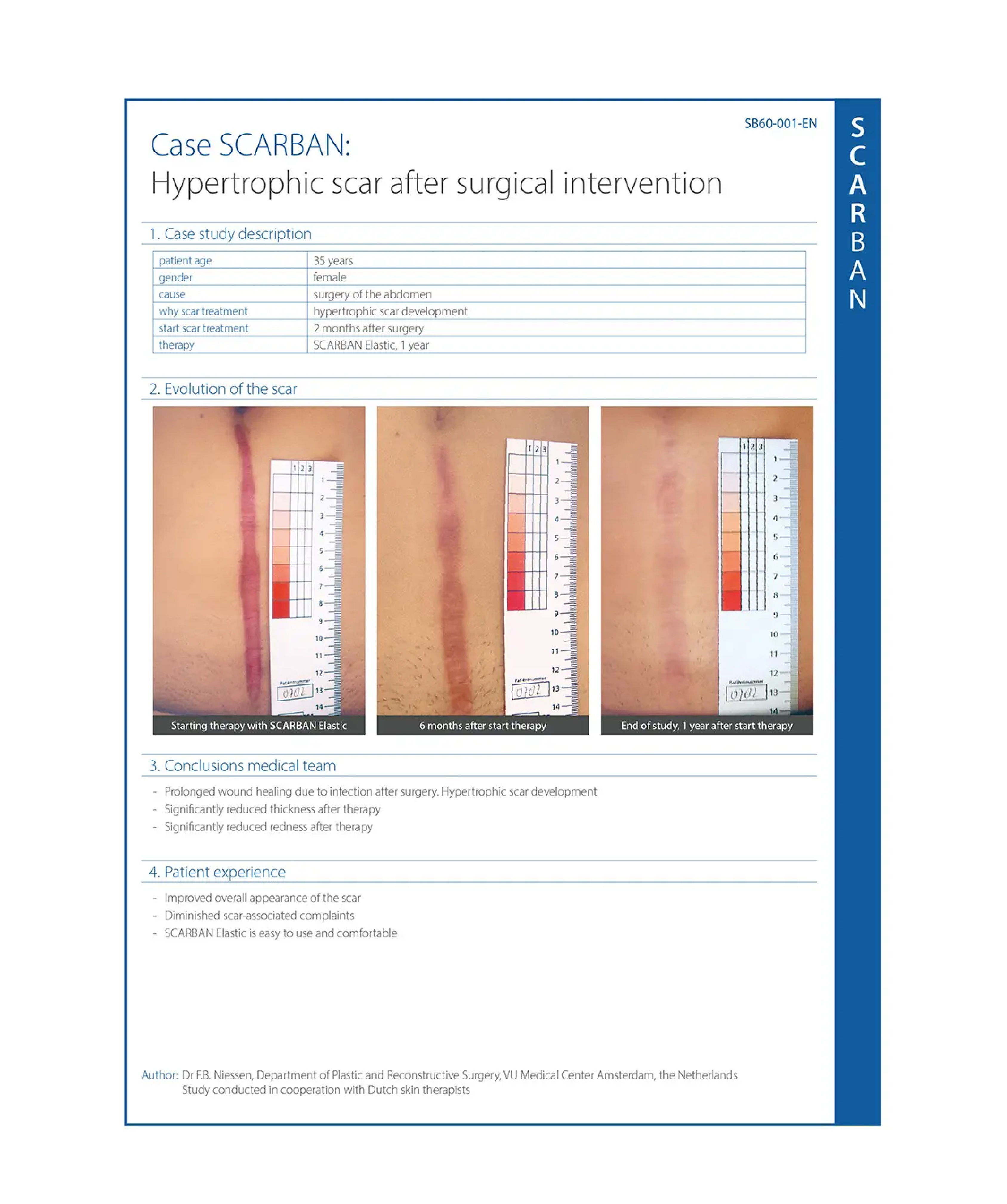 Hypertrophic scar case study 01