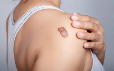 Keloid goed
