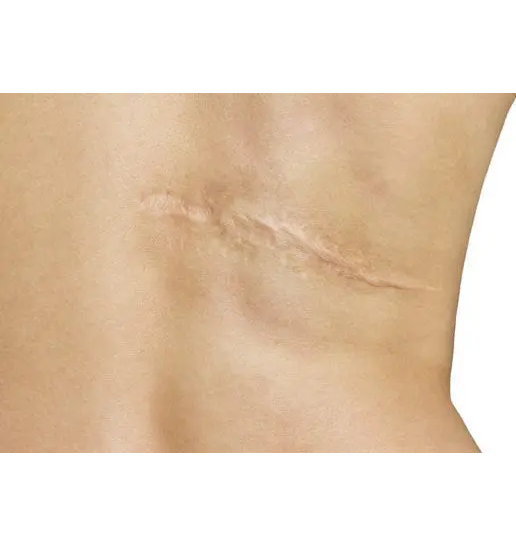 What is scar